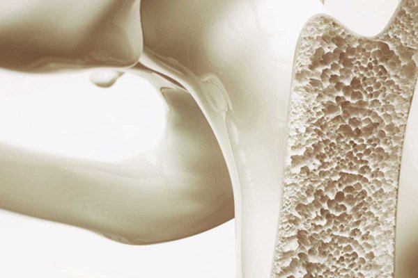 Kemik Erimesi (Osteoporoz) Belirtileri, Tanısı ve Tedavisi