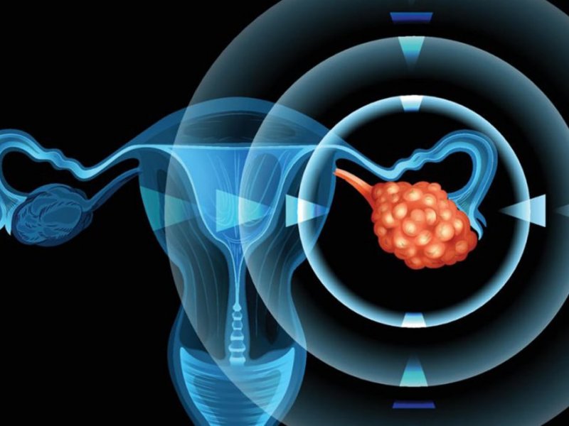 Jinekolojik Onkoloji (Genital Kanserler)