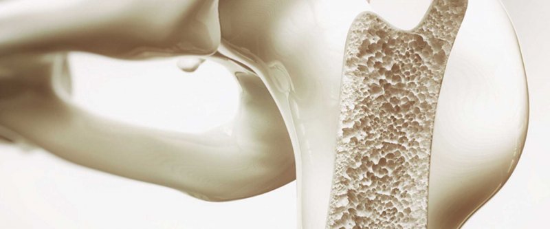 Kemik Erimesi (Osteoporoz) Belirtileri, Tanısı ve Tedavisi